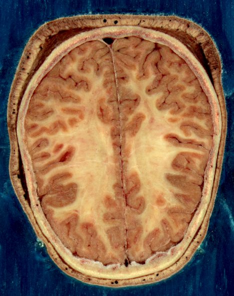 Головной мозг взрослой женщины в разрезе