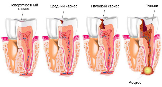 Почему человечество страдает от кариеса, и можно ли с этим бороться