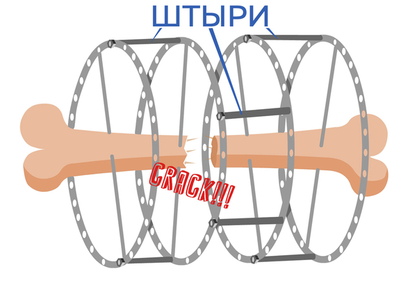 Аппарат Илизарова Аппарат Илизарова