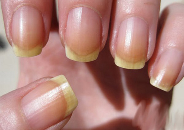 Желтоватый оттенок ногтей