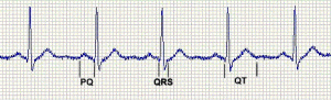 Показатели и расшифровка экг сердца