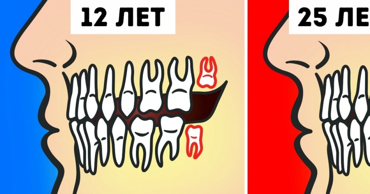 Нужно ли на самом деле удалять зубы мудрости? Удалять или нет зубы мудрости