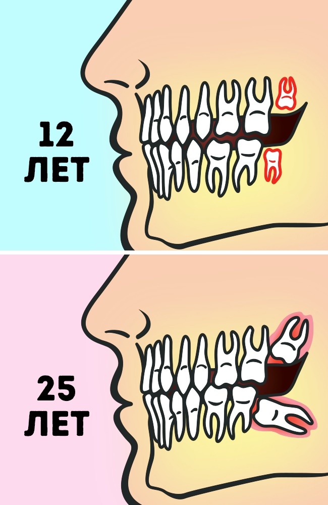 Удалять или нет зубы мудрости